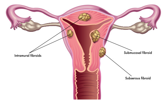 Types of fibroid